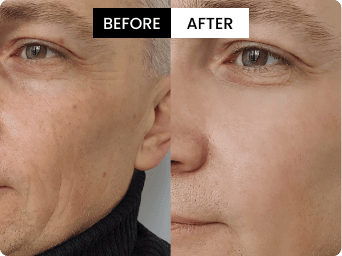 Nate before and after result