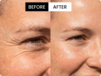 Sophie before and after result