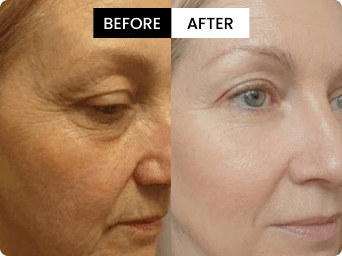 Anna before and after result