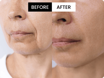 Patricia before and after result